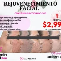 Rejuvenecimiento con láser CO2